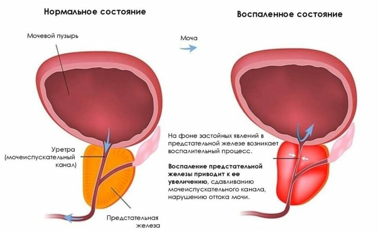 Секрет простаты фото жидкости