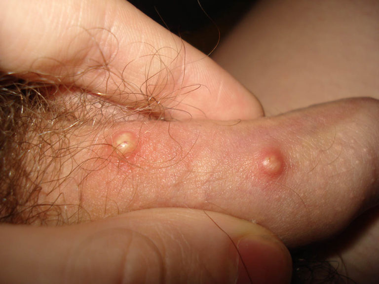сифилис у мужчин– опасное венерическое заболевание