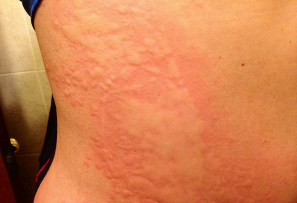 Аллергия появляется из-за передозировки или врожденной склонности к аллергии на препарат