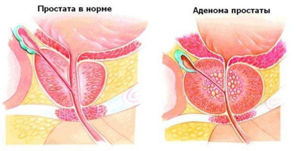 Аденома предстательной железы