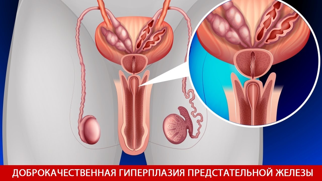 Уретра предстательной железы. Предстательная железа у мужчин. Воспаление предстательной железы. Предстательная железа у женщин.