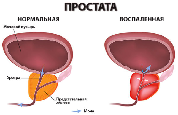 Нормальная и воспаленная простата