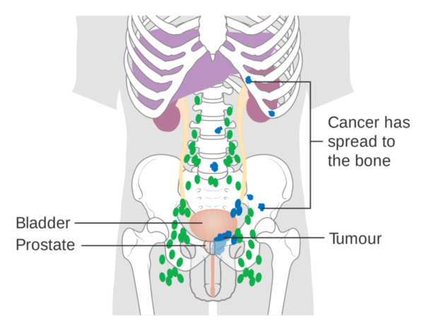 Диаграмма метастазирования рака простаты в костную ткань. Данные Британского центра исследования рака, CRUK, 2014.