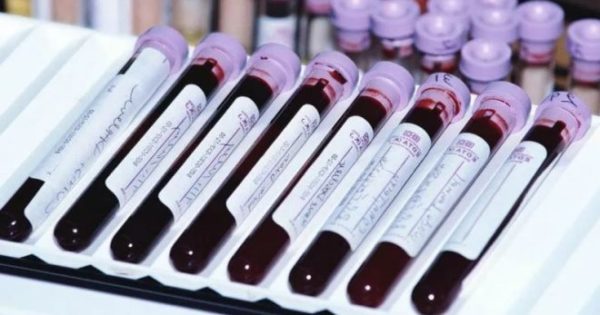 Анализ крови на гормоны ЛГ, ФСГ и пролактин