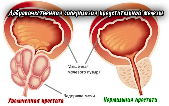Доброкачественная гиперплазия предстательной железы