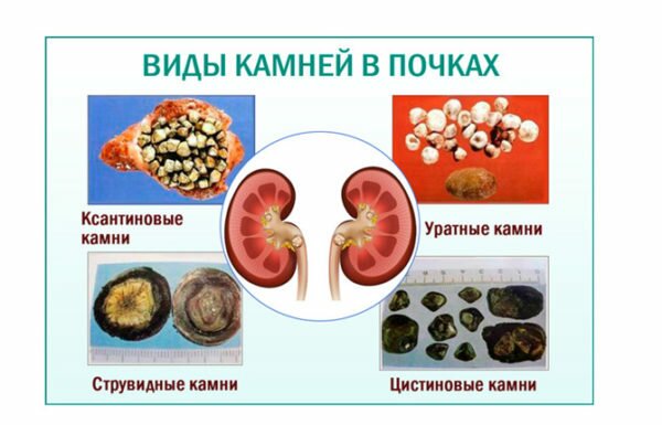 Диета при мочекаменная болезнь симптомы